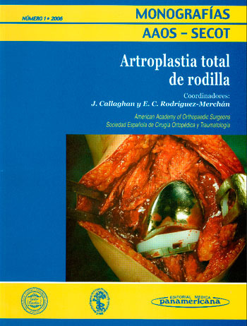 Artoplastia total de rodilla