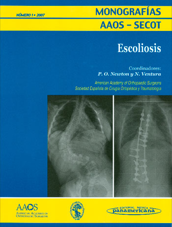 Escoliosis