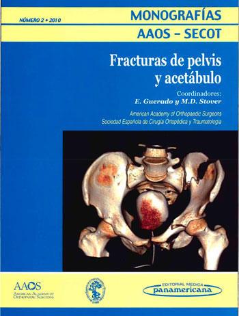 Fracturas de pelvis y acetábulo