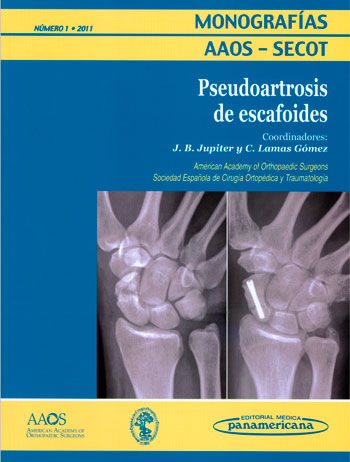 Pseudoartrosis de escafoides